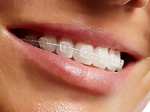 ceramic-braces
