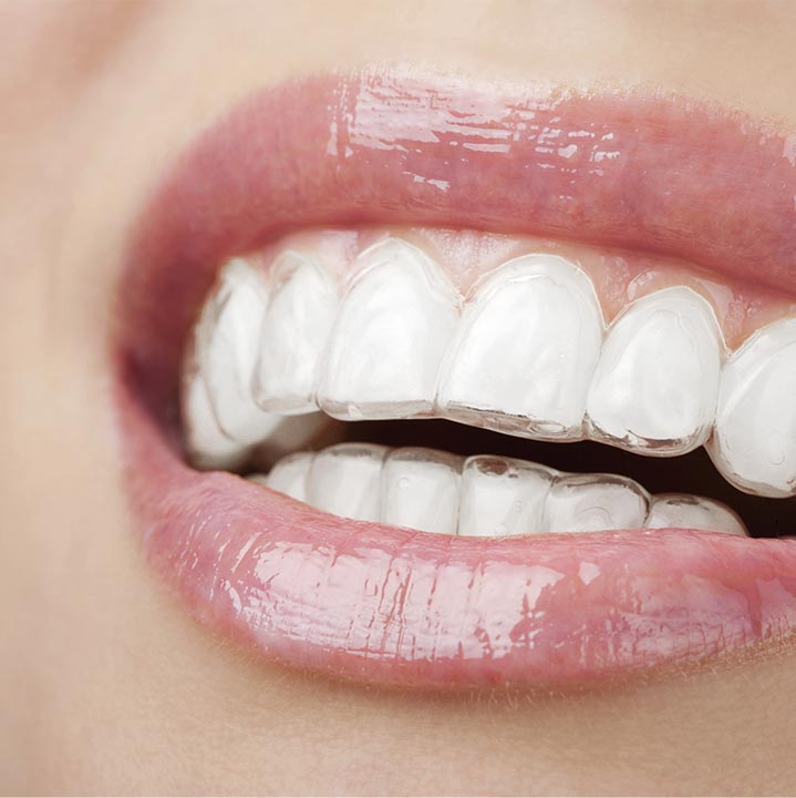 Invisalign at Grider Orthodontics